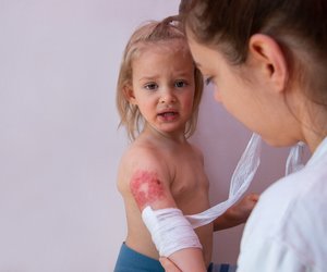Verbrennungs-Fallen: Diese Fehler machen Eltern oft unbewusst, warnt ein Kinderchirurg